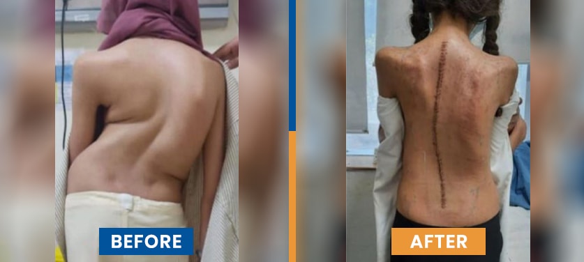 Scoliosis Surgery in India Before After